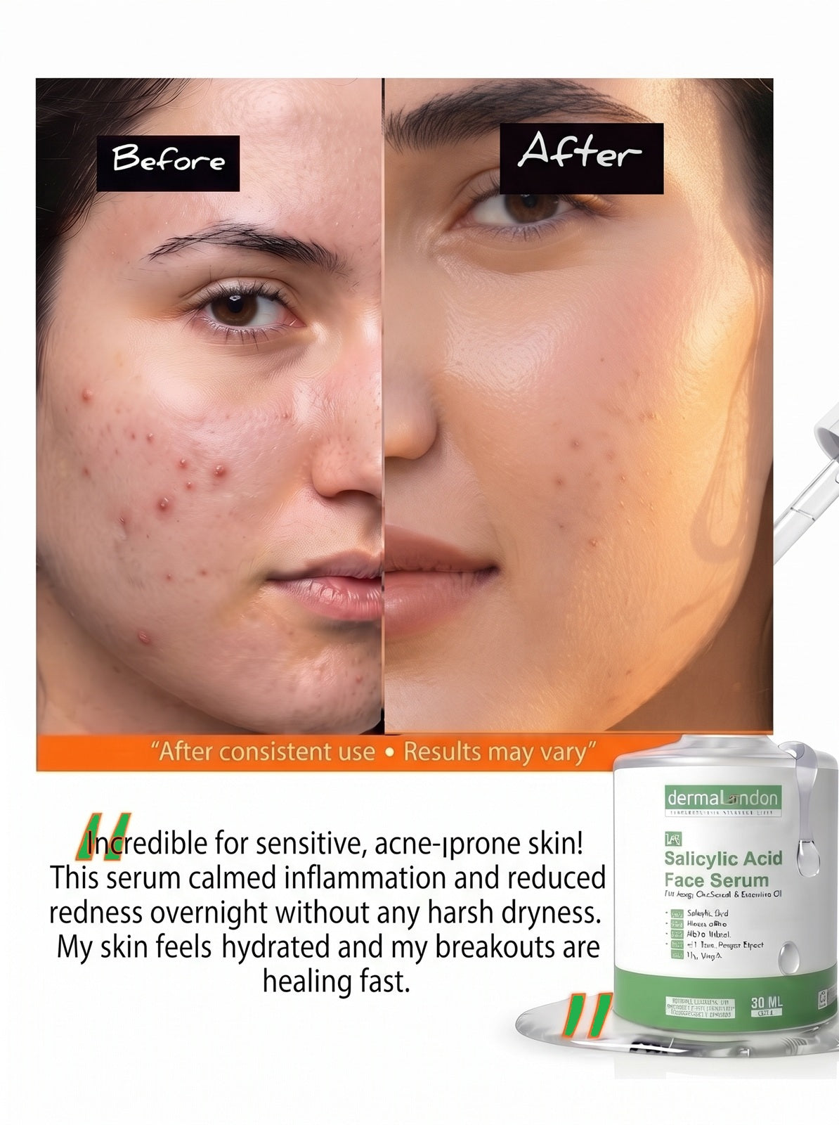 2% Salicylic Acid Face Serum with Niacinamide &amp; Alpha Arbutin – Acne, Oil &amp; Blackheads Control (30ml)