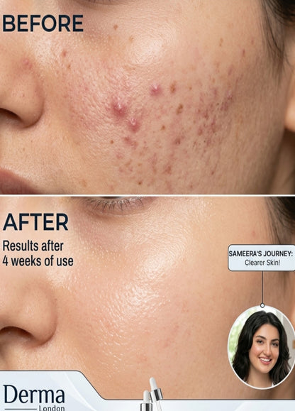 10% Niacinamide + Zinc Face Serum – Oil Control &amp; Acne Marks Solution